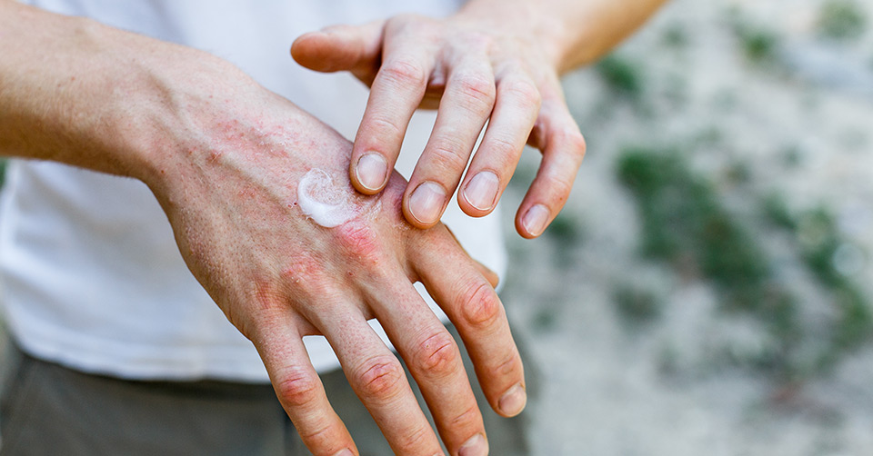 Dry Skin On Hands - Causes, Prevention & Cure | O'Keeffe's | O'Keeffe's UK